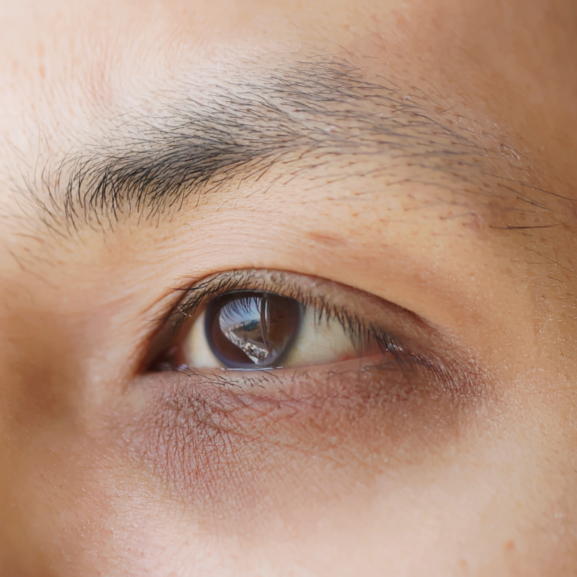 Dark Circles & Puffiness