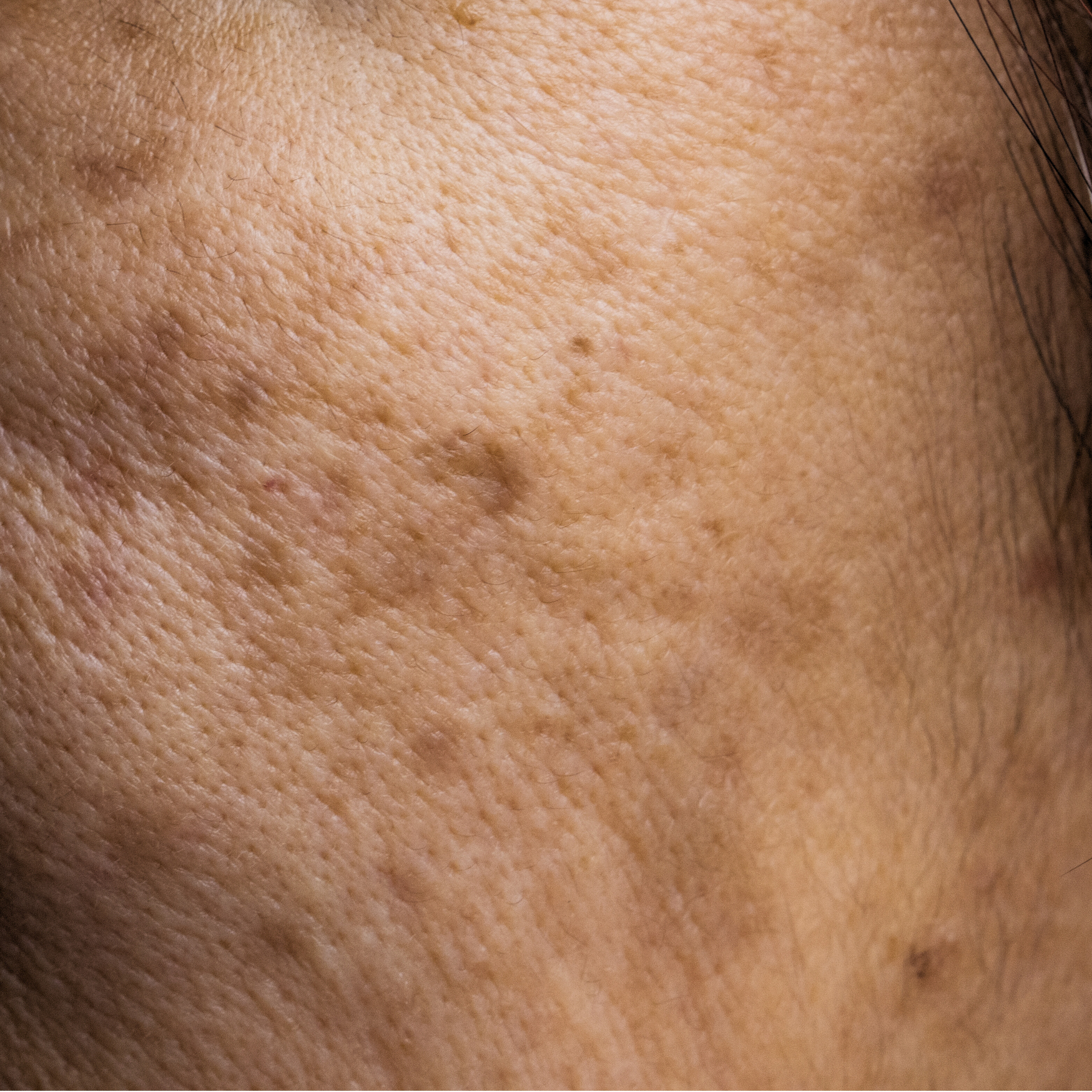 Dark Spots & Pigmentation