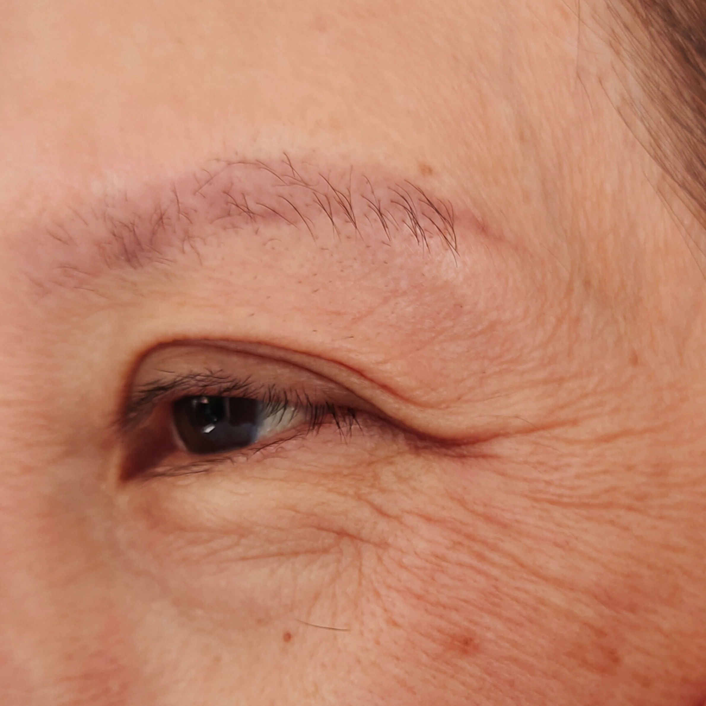 Fine Lines & Wrinkles