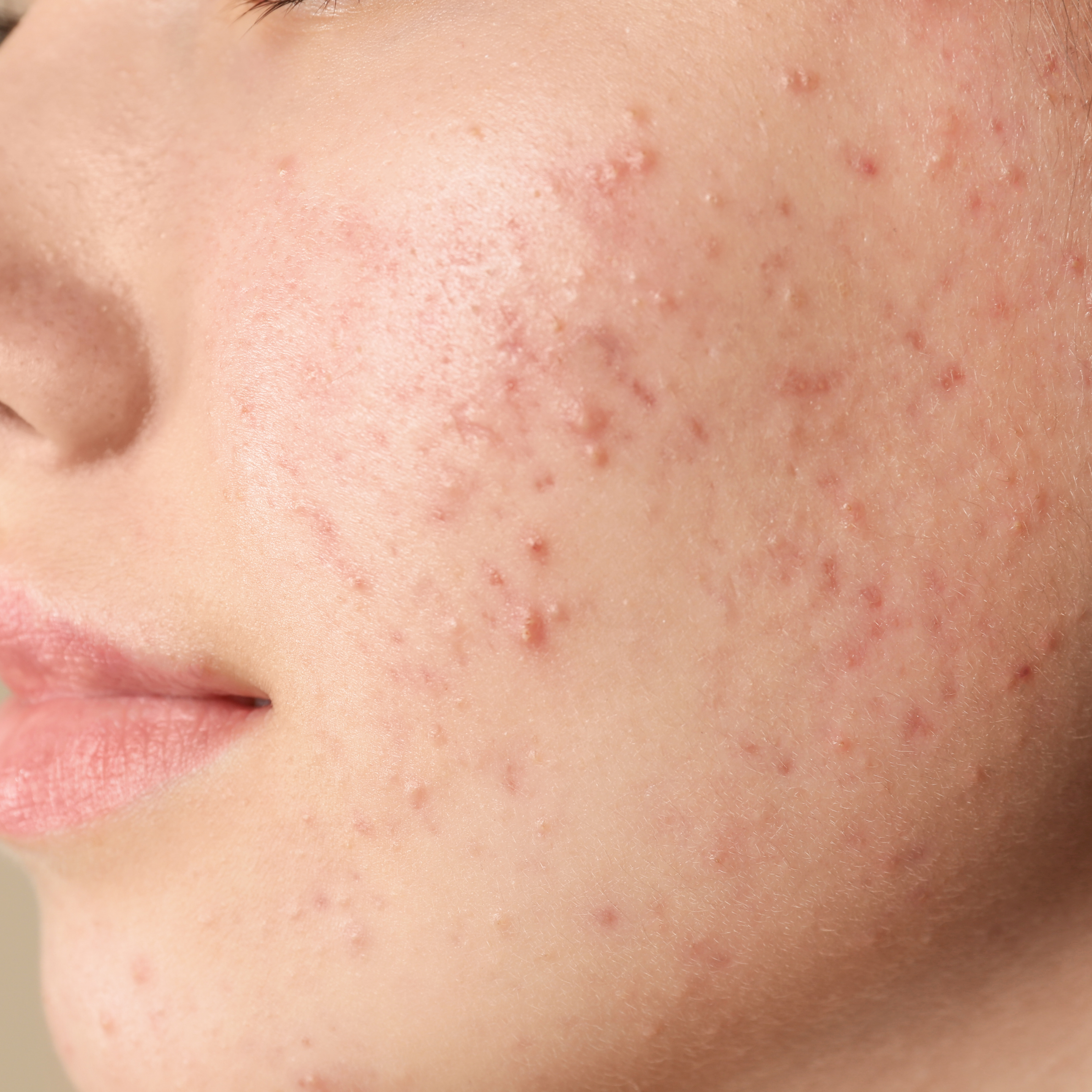 Acne & Scars